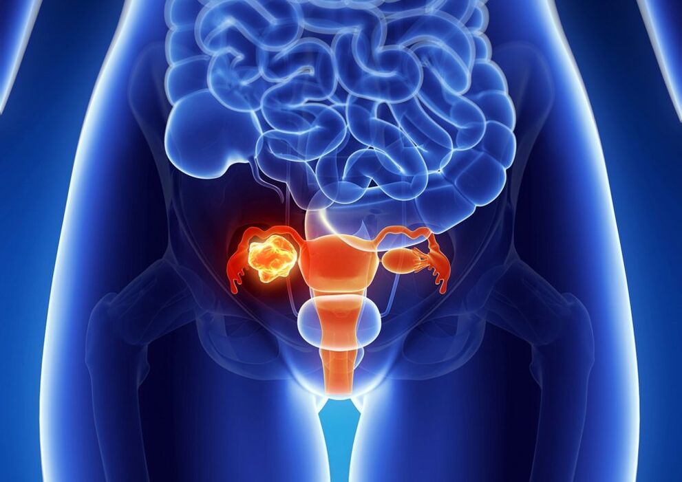 Patologia do ovário da mulher sob a influência do álcool